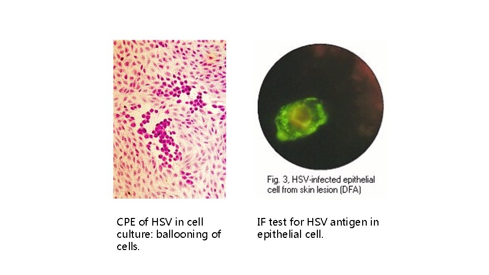 CPE of HSV in cell culture: ballooning of cells. IF test for HSV antigen