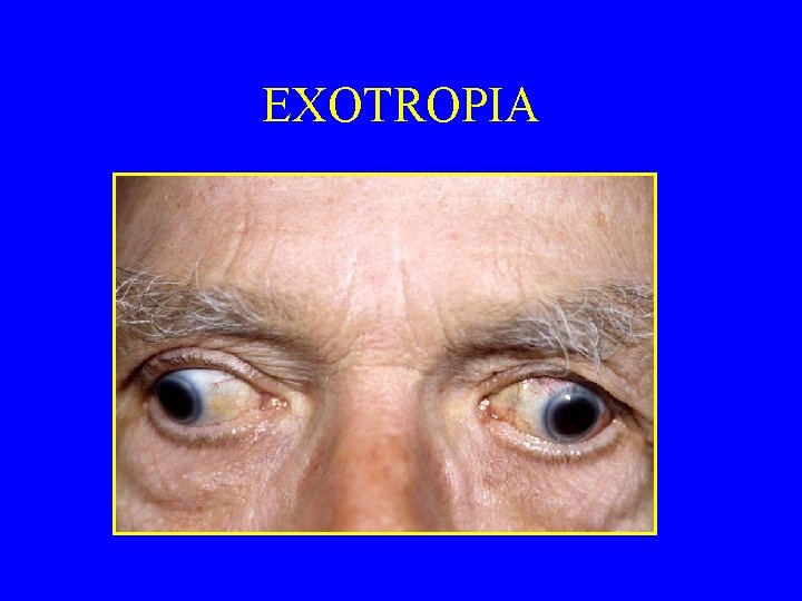 EXOTROPIA 
