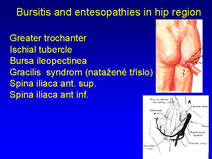 Bursitis and entesopathies in hip region Greater trochanter Ischial tubercle Bursa ileopectinea Gracilis syndrom