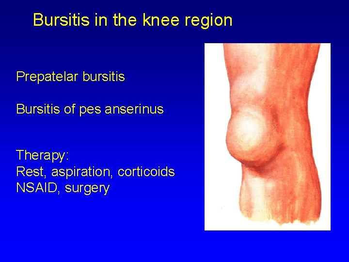 Bursitis in the knee region Prepatelar bursitis Bursitis of pes anserinus Therapy: Rest, aspiration,