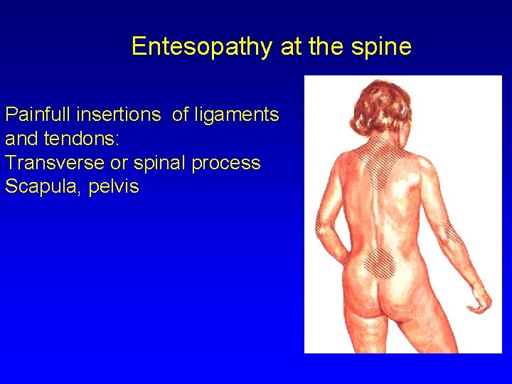 Entesopathy at the spine Painfull insertions of ligaments and tendons: Transverse or spinal process