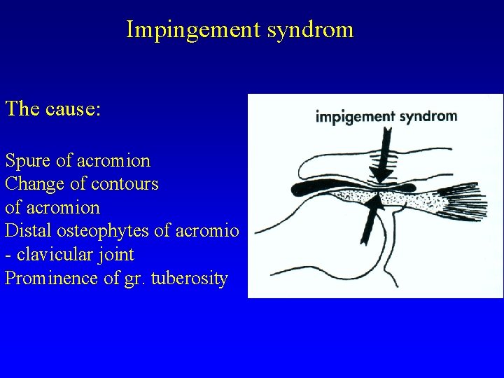 Impingement syndrom The cause: Spure of acromion Change of contours of acromion Distal osteophytes