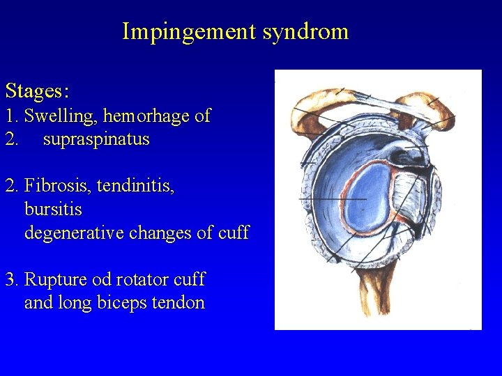 Impingement syndrom Stages: 1. Swelling, hemorhage of 2. supraspinatus 2. Fibrosis, tendinitis, bursitis degenerative