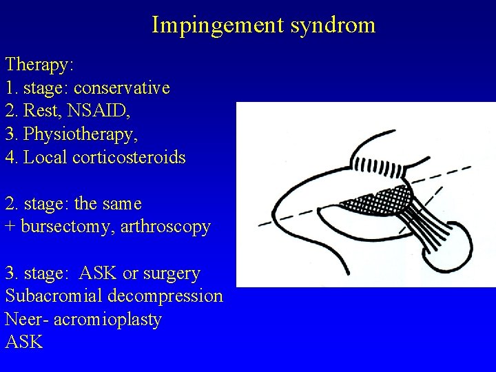 Impingement syndrom Therapy: 1. stage: conservative 2. Rest, NSAID, 3. Physiotherapy, 4. Local corticosteroids