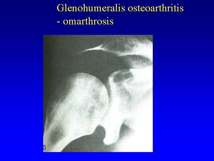 Glenohumeralis osteoarthritis - omarthrosis 