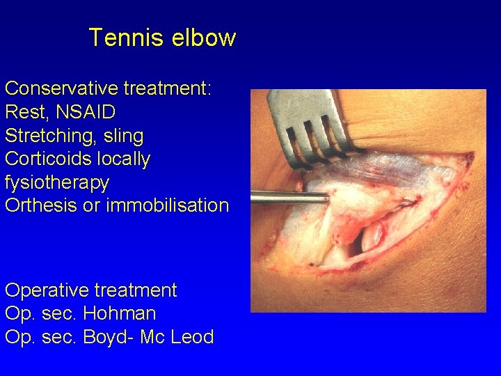 Tennis elbow Conservative treatment: Rest, NSAID Stretching, sling Corticoids locally fysiotherapy Orthesis or immobilisation