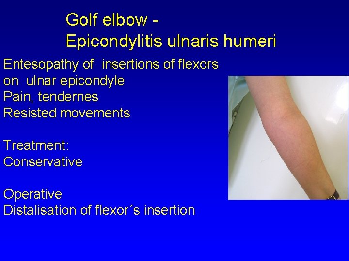 Golf elbow Epicondylitis ulnaris humeri Entesopathy of insertions of flexors on ulnar epicondyle Pain,