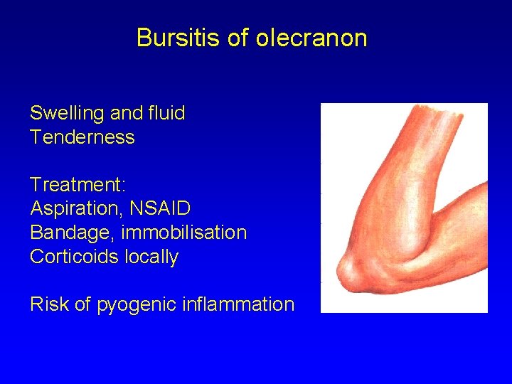 Bursitis of olecranon Swelling and fluid Tenderness Treatment: Aspiration, NSAID Bandage, immobilisation Corticoids locally