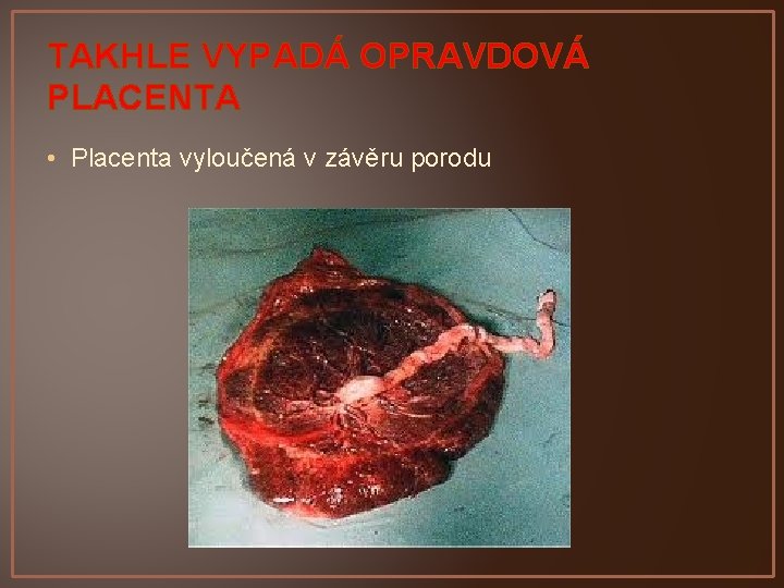 TAKHLE VYPADÁ OPRAVDOVÁ PLACENTA • Placenta vyloučená v závěru porodu 