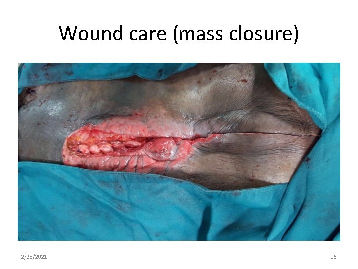 Wound care (mass closure) 2/25/2021 16 