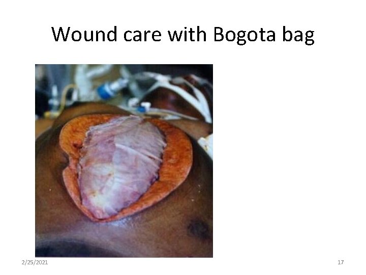 Wound care with Bogota bag 2/25/2021 17 