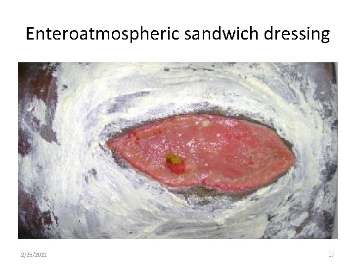 Enteroatmospheric sandwich dressing 2/25/2021 19 