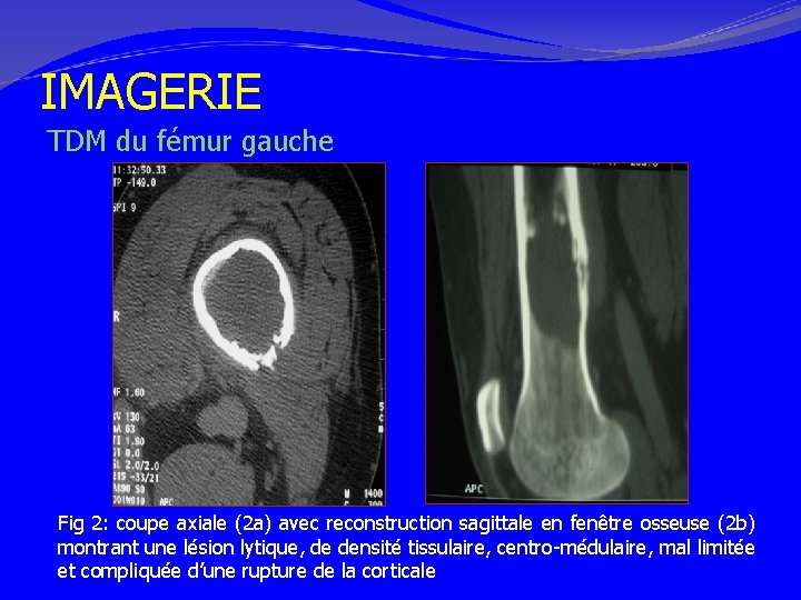 IMAGERIE TDM du fémur gauche Fig 2: coupe axiale (2 a) avec reconstruction sagittale