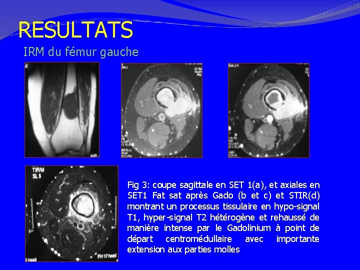 RESULTATS IRM du fémur gauche Fig 3: coupe sagittale en SET 1(a), et axiales