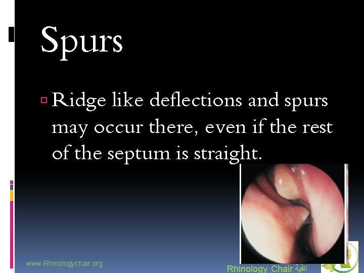 Spurs Ridge like deflections and spurs may occur there, even if the rest of