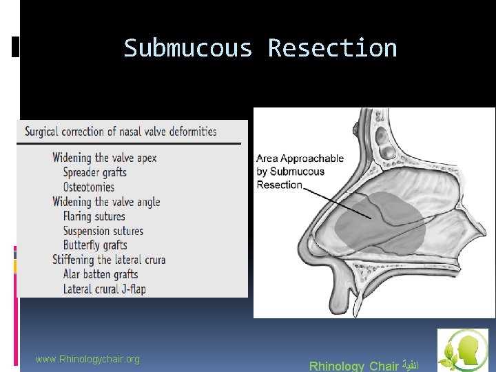 Submucous Resection www. Rhinologychair. org Rhinology Chair ﺍﻧﻔﻴﺔ 