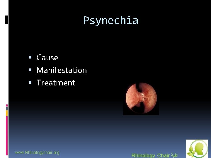 Psynechia Cause Manifestation Treatment www. Rhinologychair. org Rhinology Chair ﺍﻧﻔﻴﺔ 