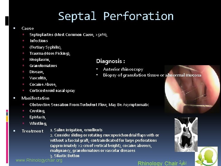 Septal Perforation Cause Manifestation Septoplasties (Most Common Cause, >50%), Infections (Tertiary Syphilis), Trauma (Nose