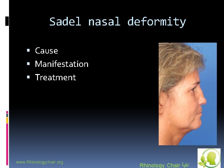 Sadel nasal deformity Cause Manifestation Treatment www. Rhinologychair. org Rhinology Chair ﺍﻧﻔﻴﺔ 