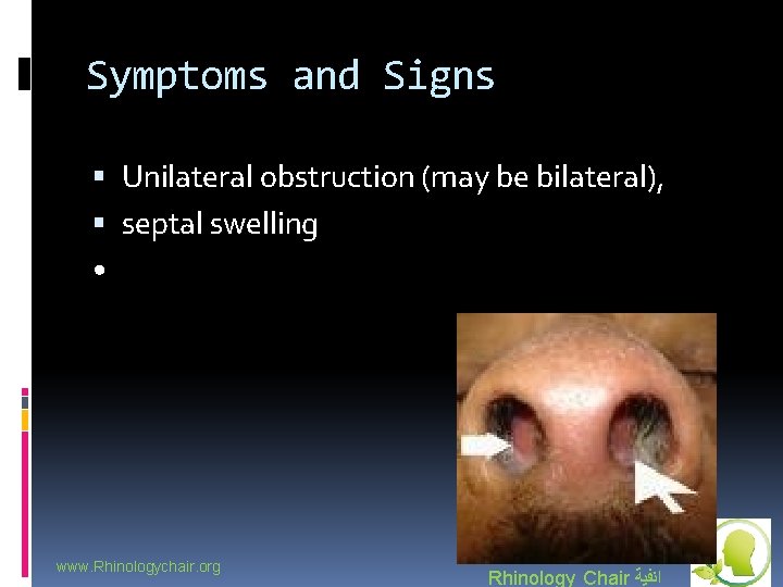 Symptoms and Signs Unilateral obstruction (may be bilateral), septal swelling • www. Rhinologychair. org
