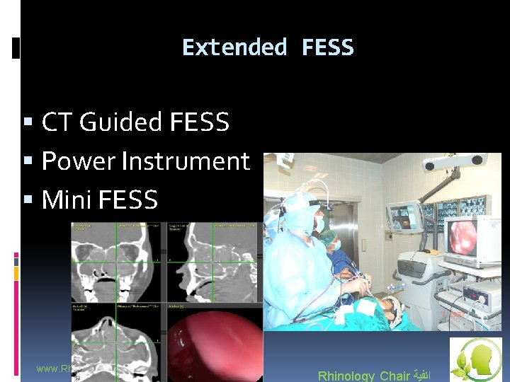 Extended FESS CT Guided FESS Power Instrument Mini FESS www. Rhinologychair. org Rhinology Chair