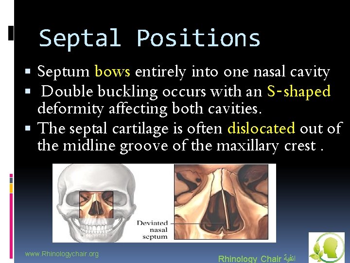 Septal Positions Septum bows entirely into one nasal cavity Double buckling occurs with an