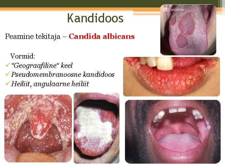 Kandidoos Peamine tekitaja – Candida albicans Vormid: ü “Geograafiline“ keel ü Pseudomembranoosne kandidoos ü