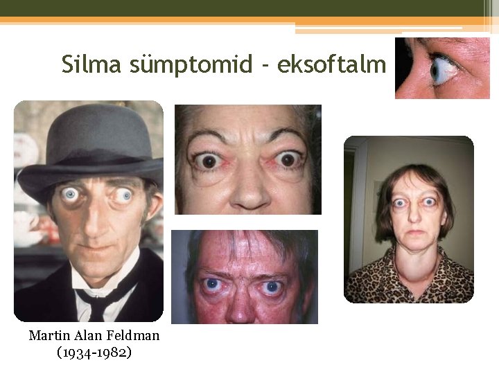 Silma sümptomid - eksoftalm Martin Alan Feldman (1934 -1982) 