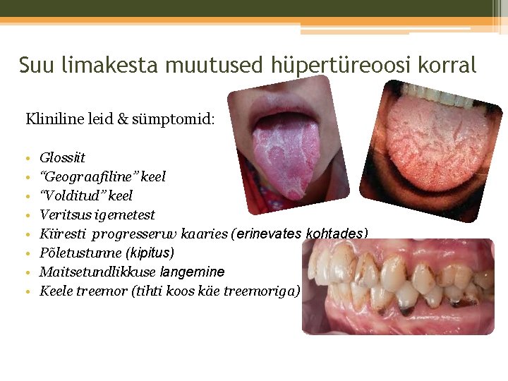 Suu limakesta muutused hüpertüreoosi korral Kliniline leid & sümptomid: • • Glossiit “Geograafiline” keel