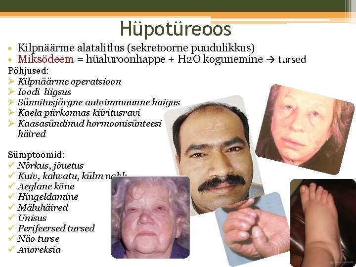 Hüpotüreoos • Kilpnäärme alatalitlus (sekretoorne puudulikkus) • Miksödeem = hüaluroonhappe + H 2 O