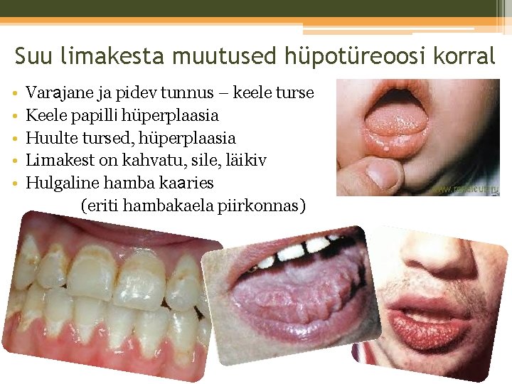 Suu limakesta muutused hüpotüreoosi korral • • • Varajane ja pidev tunnus – keele