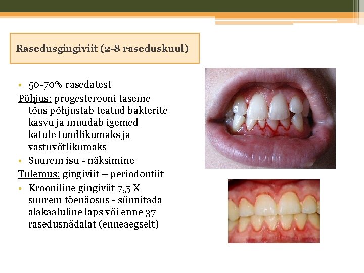 Rasedusgingiviit (2 -8 raseduskuul) • 50 -70% rasedatest Põhjus: progesterooni taseme tõus põhjustab teatud