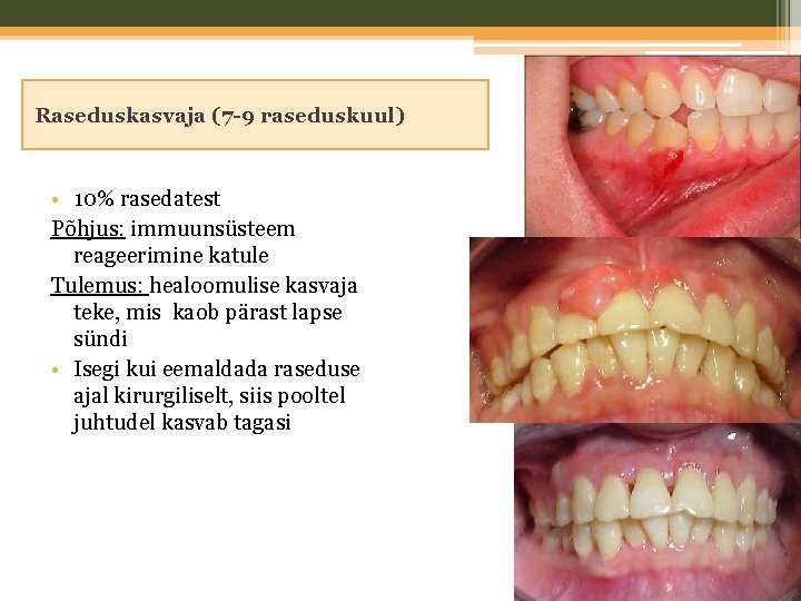 Raseduskasvaja (7 -9 raseduskuul) • 10% rasedatest Põhjus: immuunsüsteem reageerimine katule Tulemus: healoomulise kasvaja