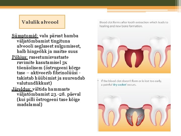 Valulik alveool Sümptomid: valu pärast hamba väljatõmbamist tingituna alveooli aeglasest sulgumisest, halb hingeõhk ja
