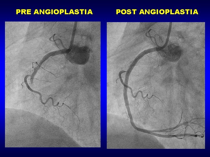 PRE ANGIOPLASTIA POST ANGIOPLASTIA 