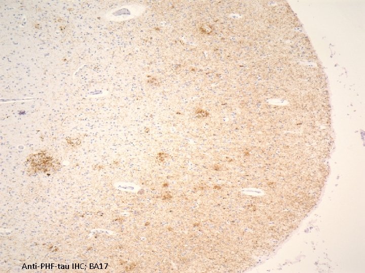 Anti-PHF-tau IHC; BA 17 