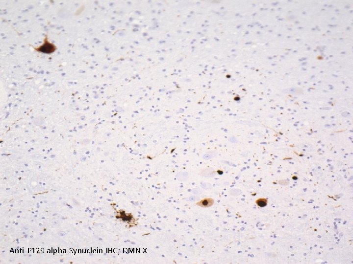 Anti-P 129 alpha-Synuclein IHC; DMN X 