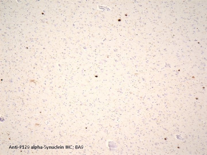 Anti-P 129 alpha-Synuclein IHC; BA 9 