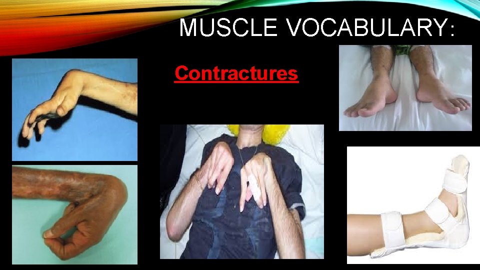MUSCLE VOCABULARY: Contractures 