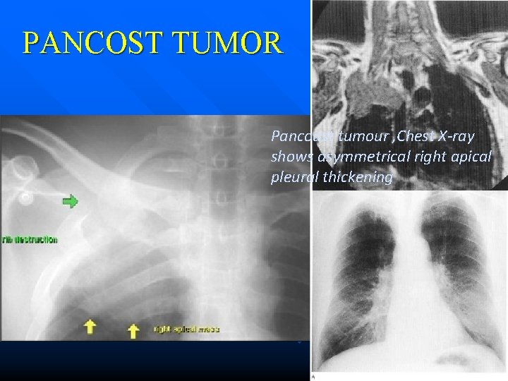 PANCOST TUMOR Pancoast tumour , Chest X-ray shows asymmetrical right apical pleural thickening 