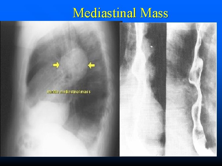 Mediastinal Mass 