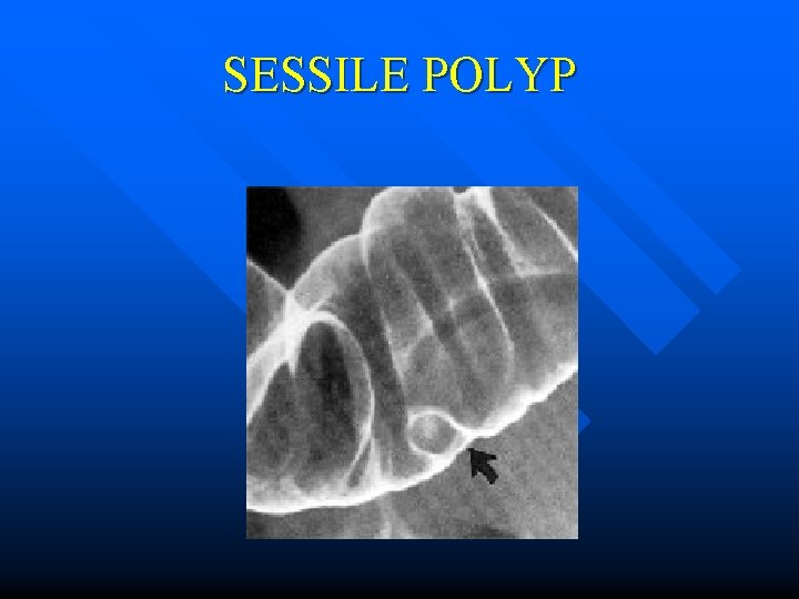 SESSILE POLYP 