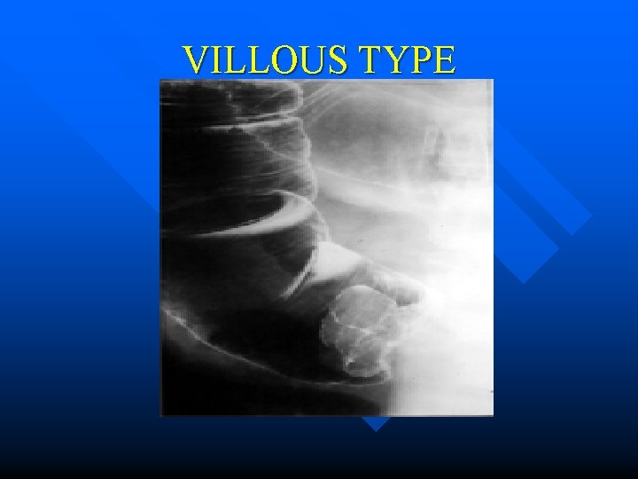 VILLOUS TYPE 