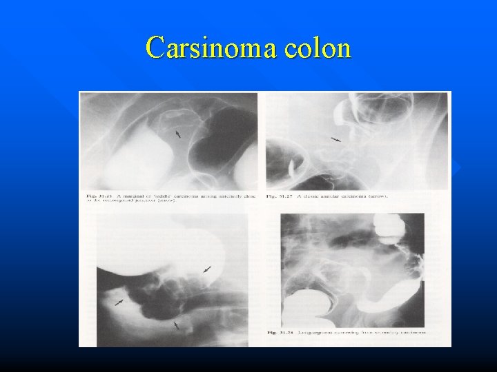 Carsinoma colon 