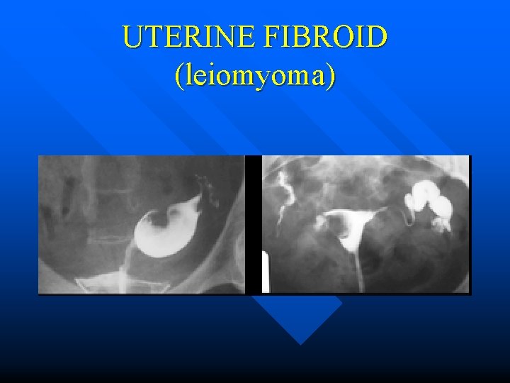 UTERINE FIBROID (leiomyoma) 