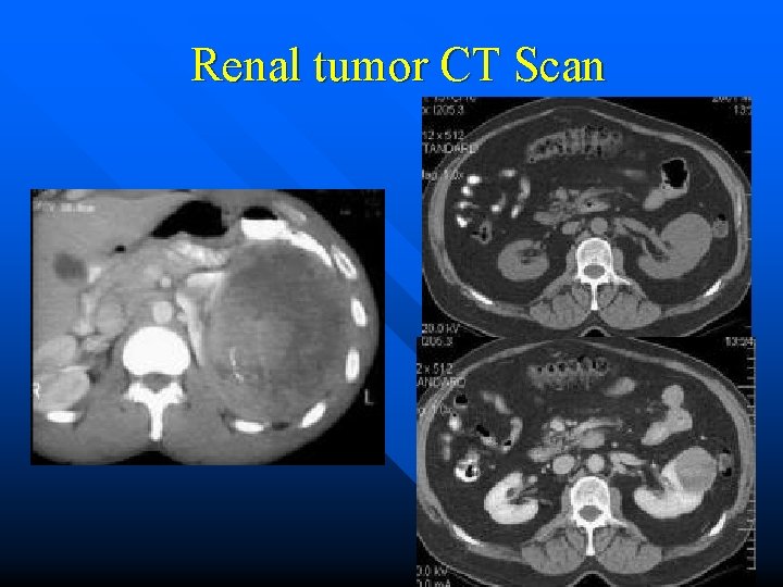 Renal tumor CT Scan 