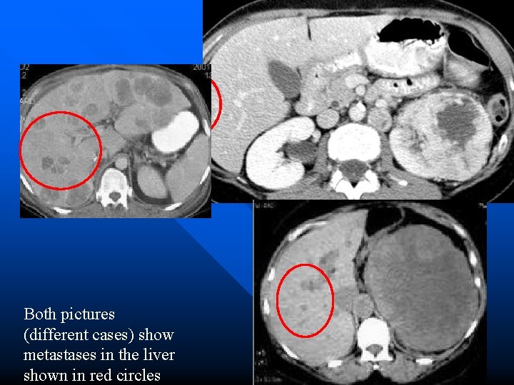 Both pictures (different cases) show metastases in the liver shown in red circles 