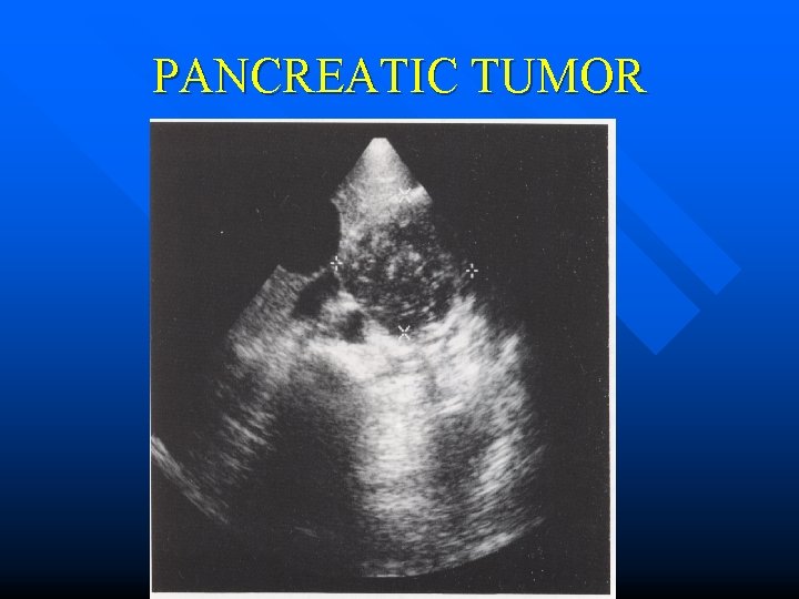 PANCREATIC TUMOR 