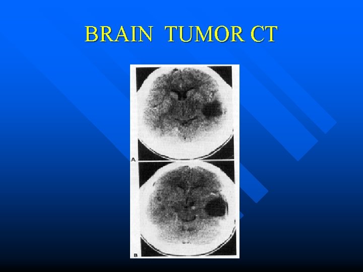 BRAIN TUMOR CT 