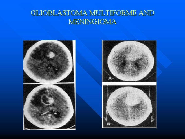 GLIOBLASTOMA MULTIFORME AND MENINGIOMA 